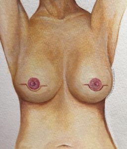 Traditional Nipple Sparing Mastectomy Scars