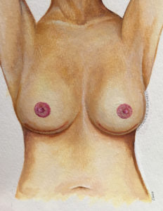 Traditional Nipple Sparing Mastectomy Scars